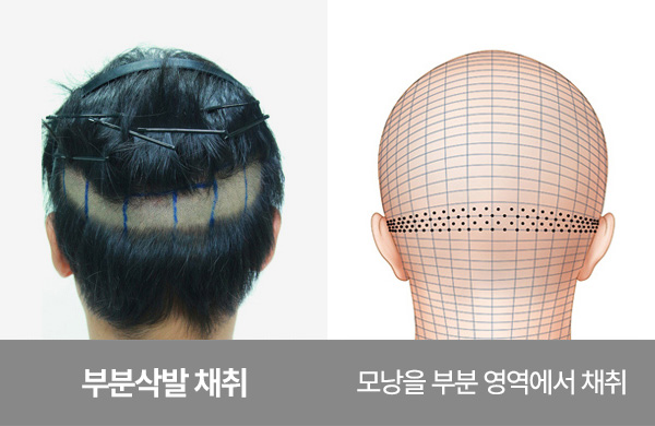 부분삭발 모발이식 채취 방식