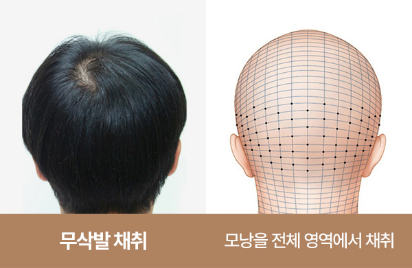 무삭발 모발이식 채취 방식