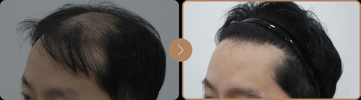 모빈치의원 비절개 무삭발 사례 사진
