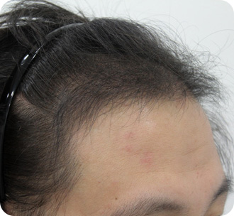 수술 후 6개월 경과 모습