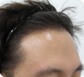 수술 후 9개월 경과 모습