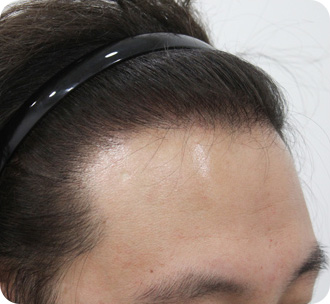 수술 후 1년 경과 모습