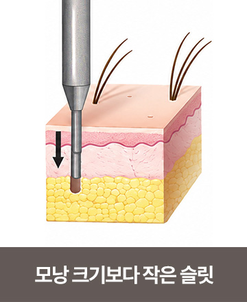 모낭 크기보다 작은 슬릿