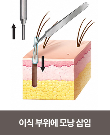 이식 부위에 모낭 삽입