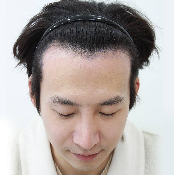 모발이식 후 이미지