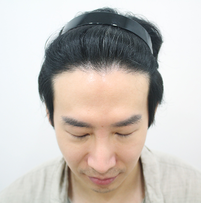 모발이식 전 이미지