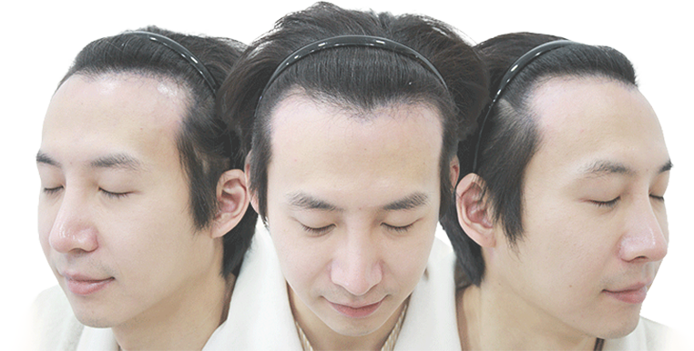 모발이식 전 이미지