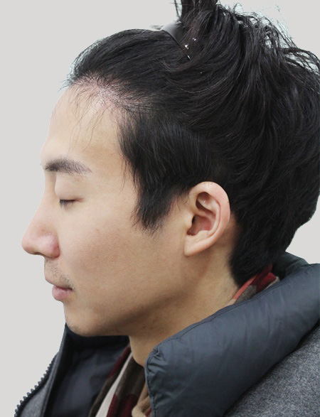 수술 후 6개월 상태