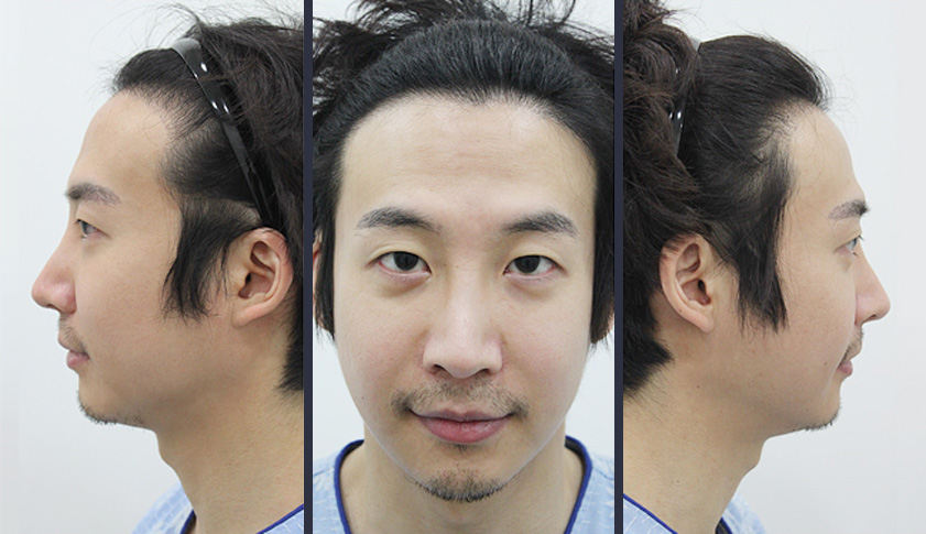 수술 후 1년 경과 사진