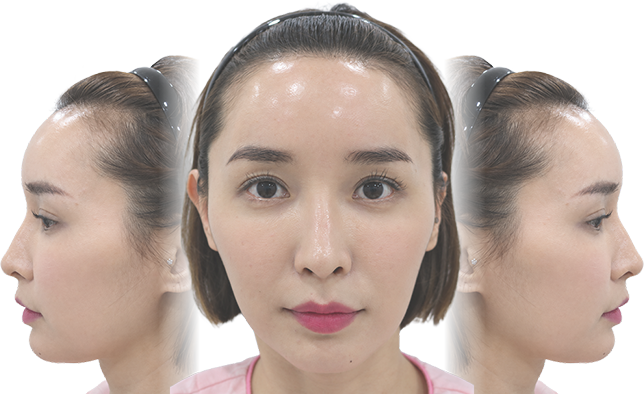헤어라인 교정 전 이미지