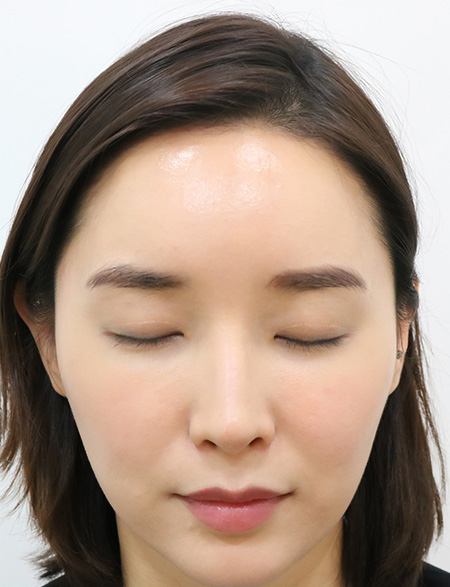 수술 후 1년 2개월 상태