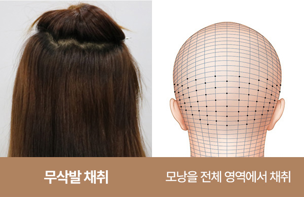 무삭발 모발이식 채취 방식