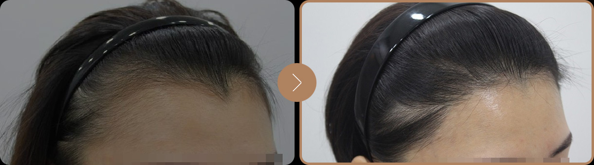 모빈치의원 비절개 무삭발 사례 사진 3