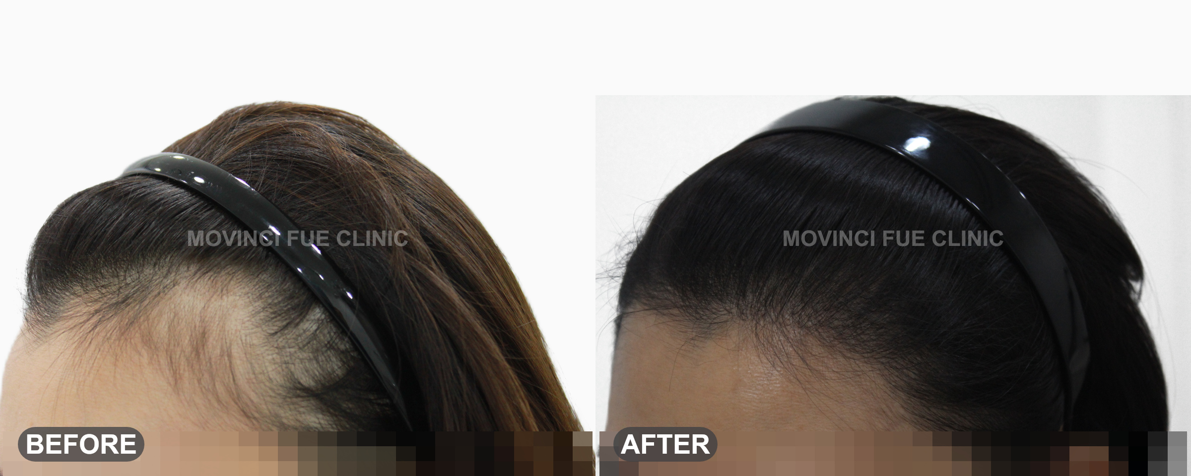 시술 전후 이미지